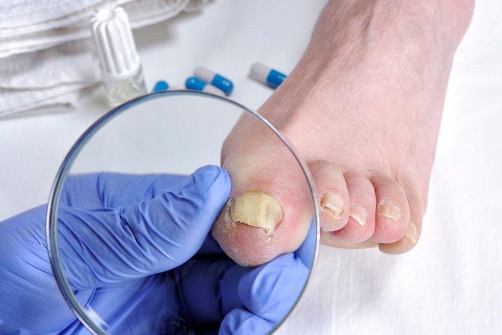 tratamiento hongo uñas pie alicante